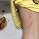 How to get rid of bed bugs quickly